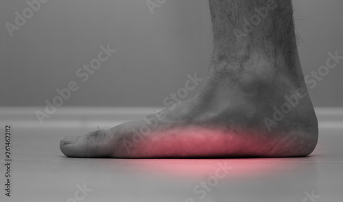 Flat feet (pes planus or fallen arches). close up of flat men foot.  photo