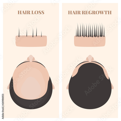 Man with thinning and restored hair in top view. Male pattern alopecia set with skin cross-section diagram. Before and after concept. Vector illustration.