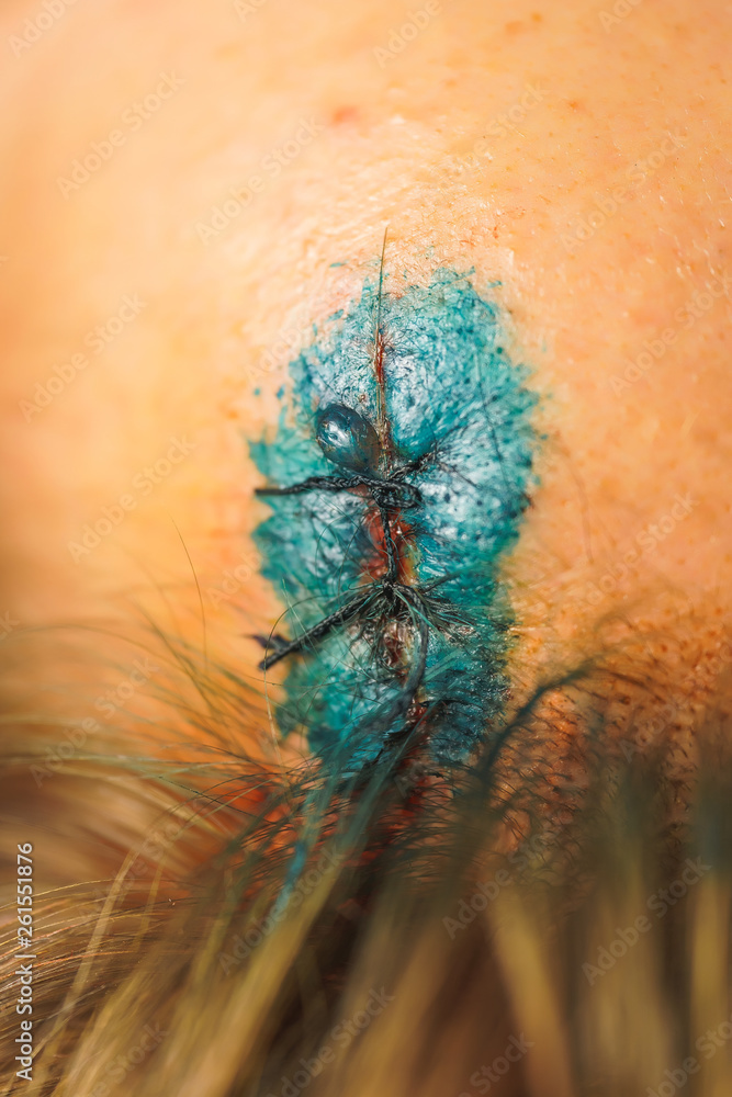 Head wound after a car accident. Brilliant green solution on the