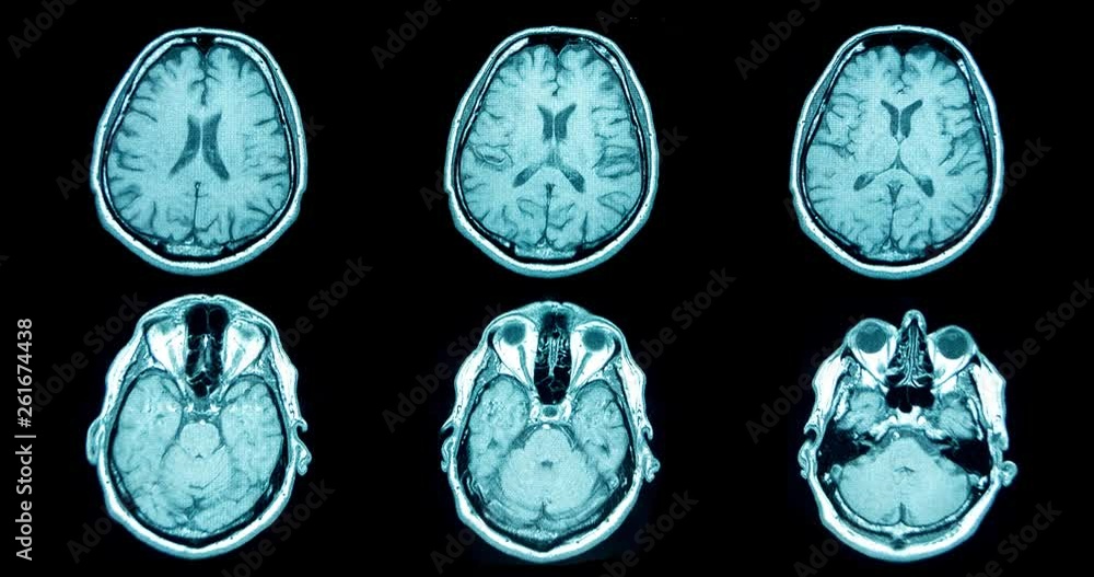 Six MRI brain shots appear on black background Six MRI brain shots appear on black background
