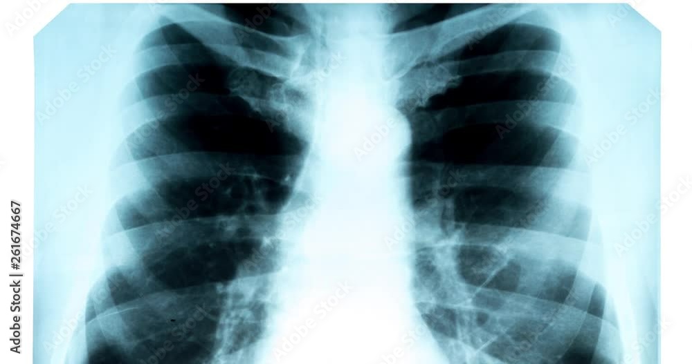 X-ray of the chest on the light screen X-ray of the chest on the light screen