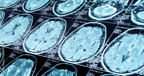 MRI scan of the brain close up are moving diagonally, looped