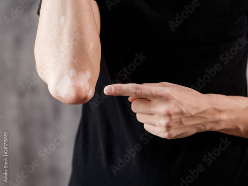 Vitiligo on hands and elbows with black background 