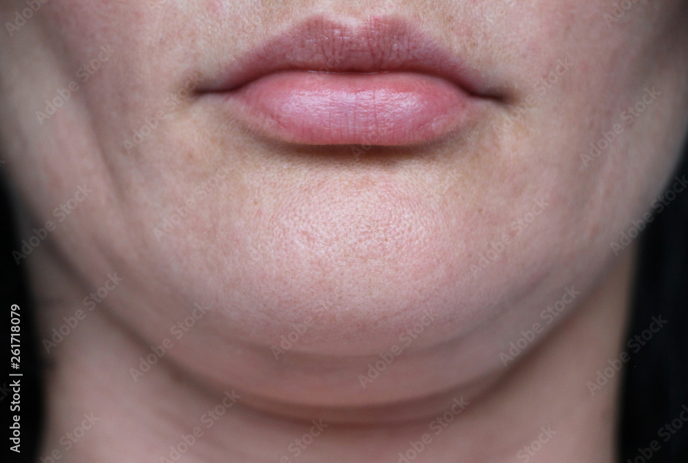 Obraz premium face line correction. a woman with a second chin RF-lifting.