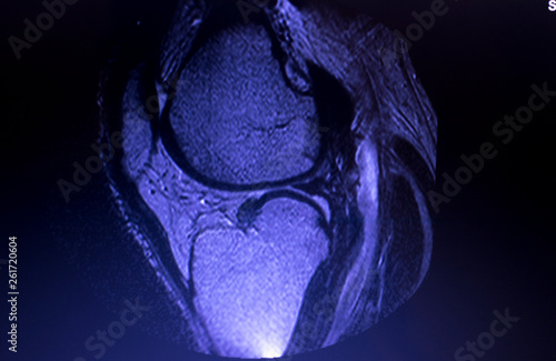 Photography MRI knee meniscus tear scan