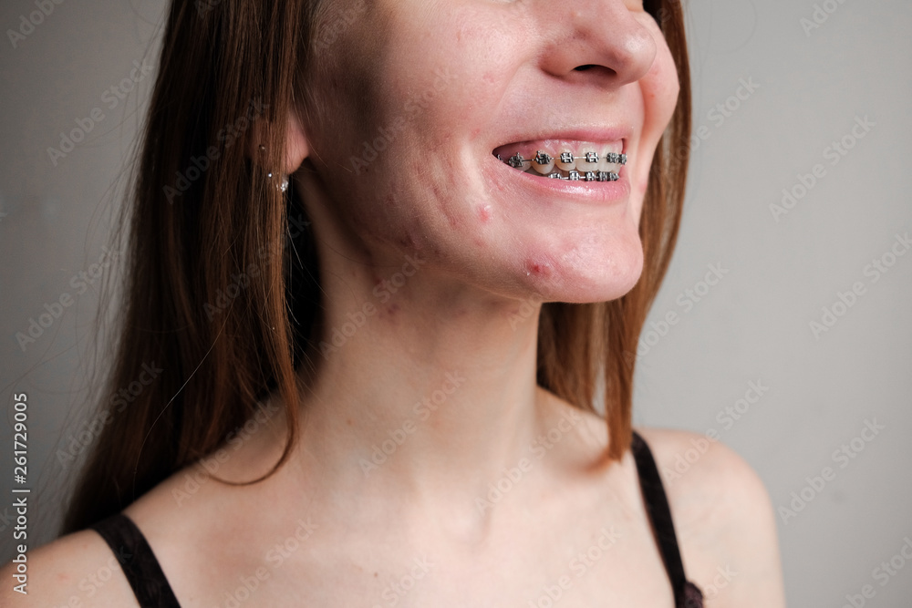 Woman with problem skin. Teen acne on young skin. Tools for removing acne. Woman with problem skin. Teen acne on young skin. Tools for removing acne.