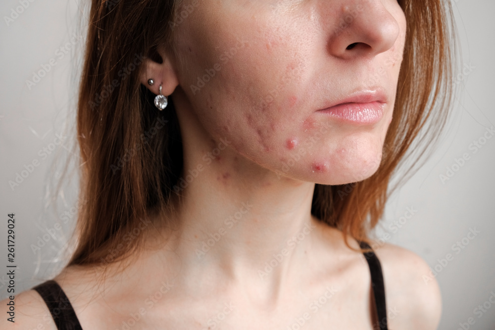 Obraz premium Woman with problem skin. Teen acne on young skin. Tools for removing acne.
