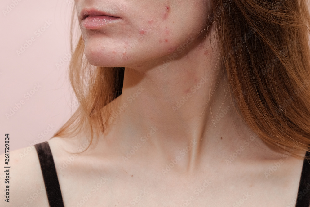 Woman with problem skin. Teen acne on young skin. Tools for removing acne. Woman with problem skin. Teen acne on young skin. Tools for removing acne.