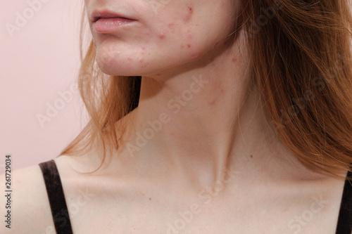 Woman with problem skin. Teen acne on young skin. Tools for removing acne.