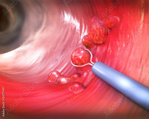 Foto Removal of a colonic polyp with a electrical wire loop during a colonoscopy - 3d