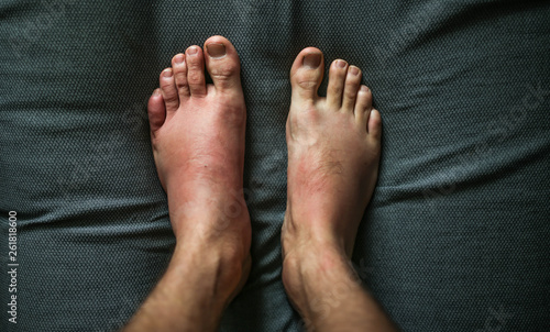 allergic reaction to the legs, swollen toes. angioedema