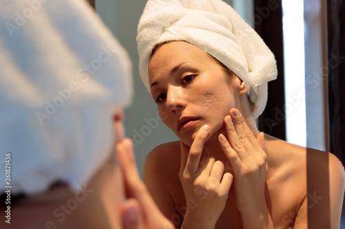 young woman looking her acne scars on the mirror photo