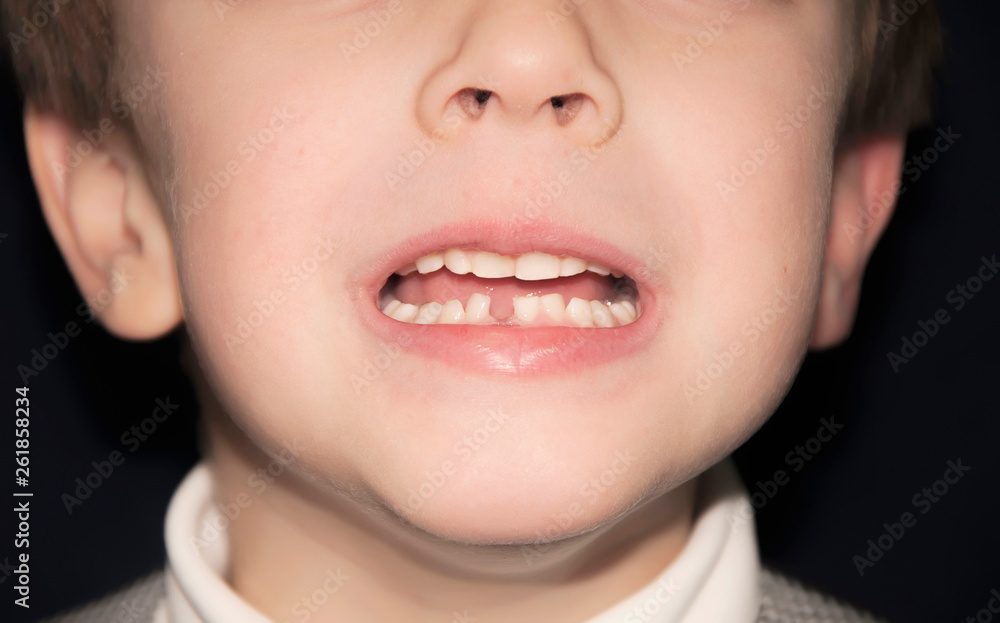 Fall out of the first tooth Fall out of the first tooth