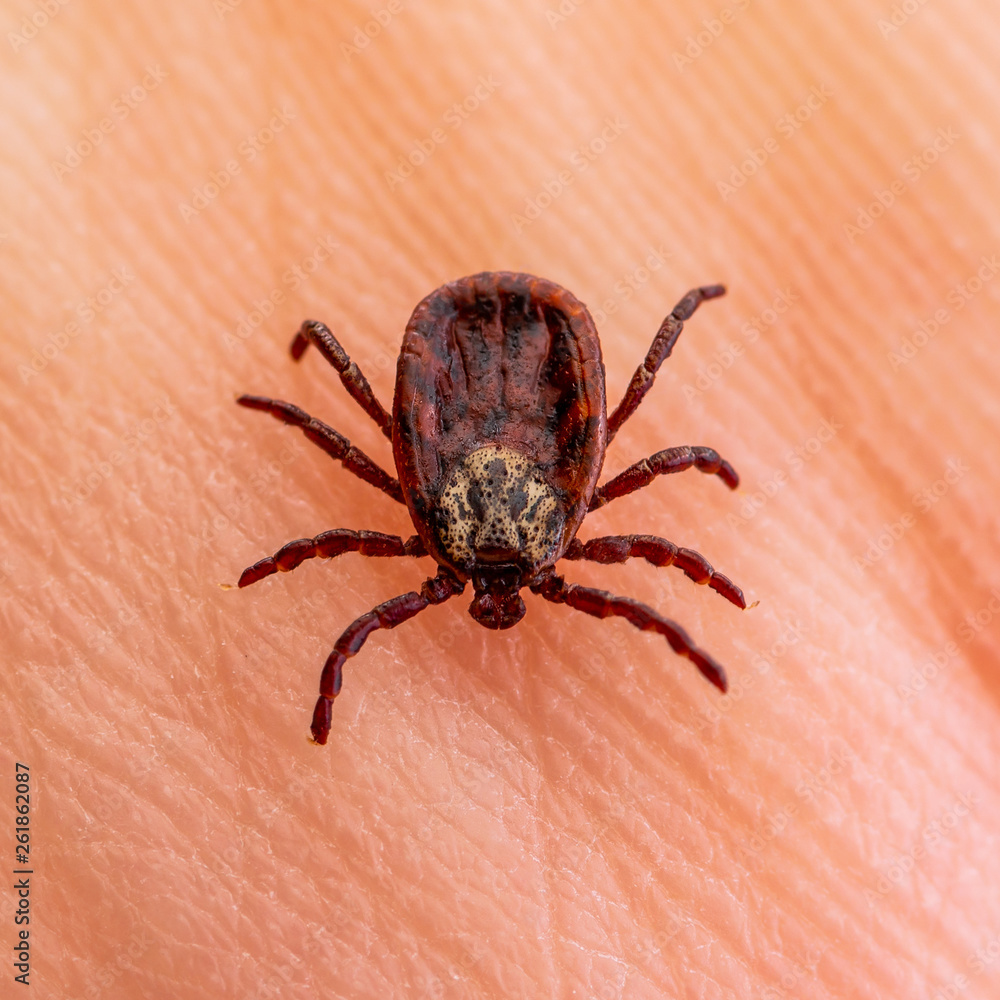 Encephalitis Virus or Lyme Borreliosis Disease Infectious Dermacentor Tick Arachnid Parasite Insect on Skin Macro Encephalitis Virus or Lyme Borreliosis Disease Infectious Dermacentor Tick Arachnid Parasite Insect on Skin Macro