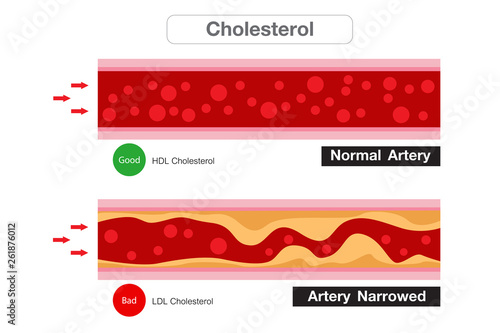 Cholesterol in artery, health risk , vector design