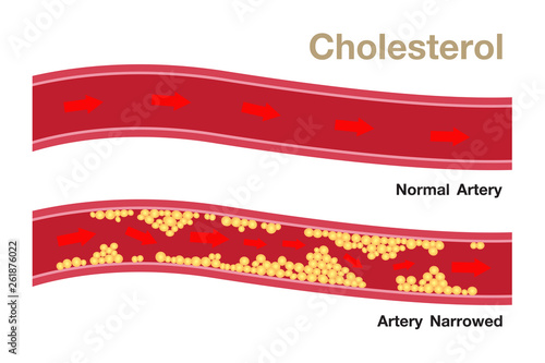 Cholesterol in artery, health risk , vector design