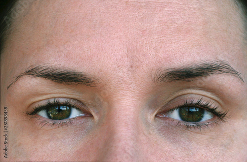 Ptosis. eyelid syndrome