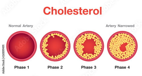 Cholesterol in artery, health risk , vector design