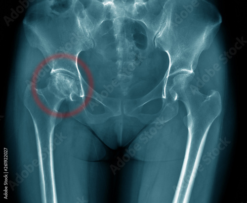 Quadro em tela x-ray image of old woman show degenerative change of hip joint, hip avascular ne