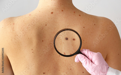 Dermatologist examining moles of patient in clinic photo