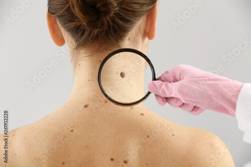 Dermatologist examining moles of patient on light background photo