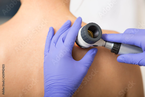 Fototapeta Doctor examining patient skin moles with dermoscope