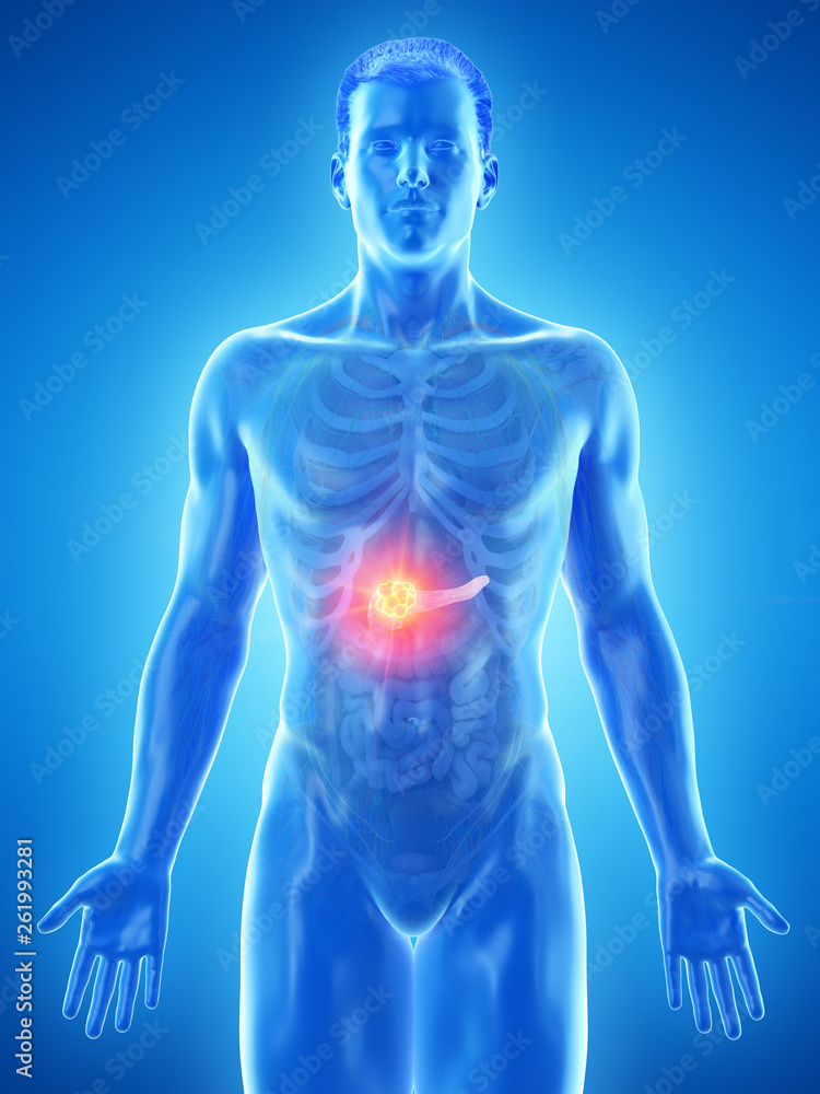 3d rendered medically accurate illustration of a mans pancreas tumor 3d rendered medically accurate illustration of a mans pancreas tumor