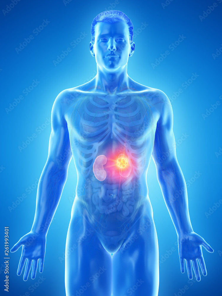 3d rendered medically accurate illustration of a mans kidneys tumor 3d rendered medically accurate illustration of a mans kidneys tumor