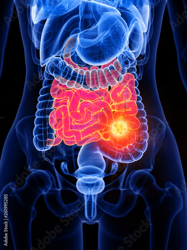 3d rendered medically accurate illustration of a womans small intestine tumor © Sebastian Kaulitzki