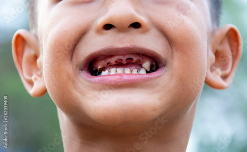 Картината върху платно Boy or children have problem with teeth about caries