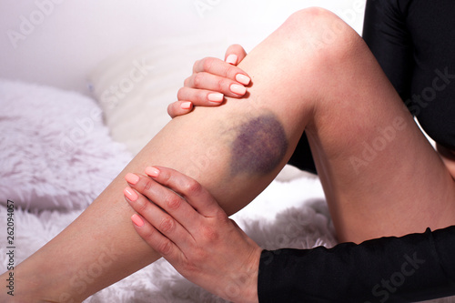 bruise from injury on the female leg