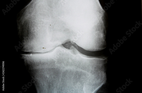 Photography X-Ray image of knee joint with advanced arthrosis (Gonarthrose)
