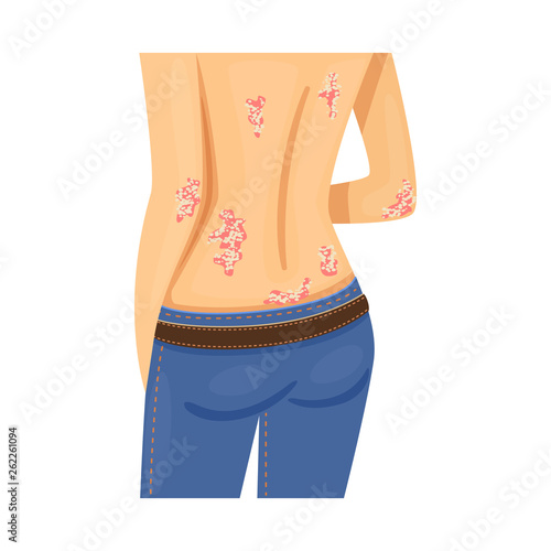 Vector illustration of psoriasis and skin logo. Set of psoriasis and eczema stock symbol for web.