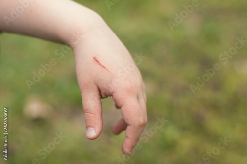 Scratch on the skin of the child on the hand. © Konstiantyn Zapylaie