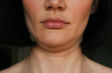 face line correction, lower facelift