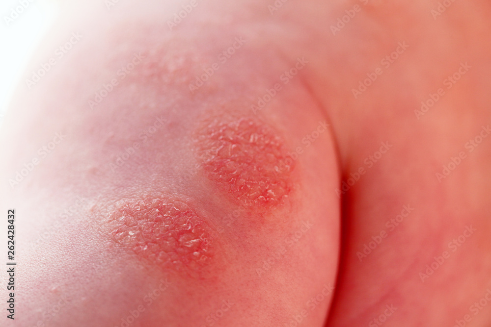 Fototapeta premium Atopic dermatitis in a child