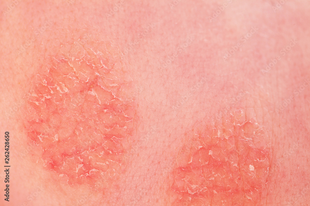 Fototapeta premium Atopic dermatitis in a child