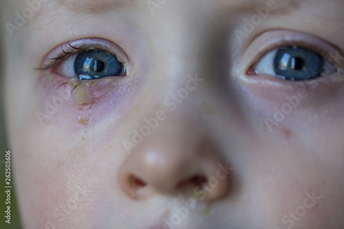 Child with purulent conjunctivitis, contagious eye infection. Symptoms and treatment concept. Close up.
