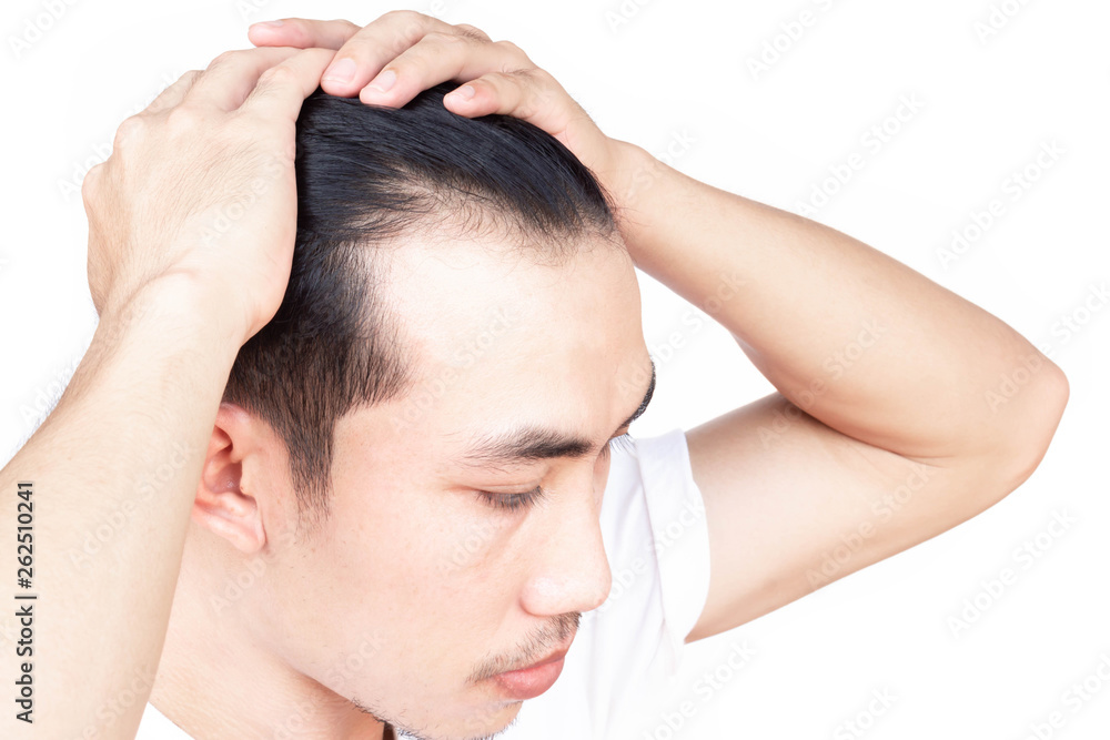 Young man serious hair loss problem for health care medical and shampoo product concept Young man serious hair loss problem for health care medical and shampoo product concept