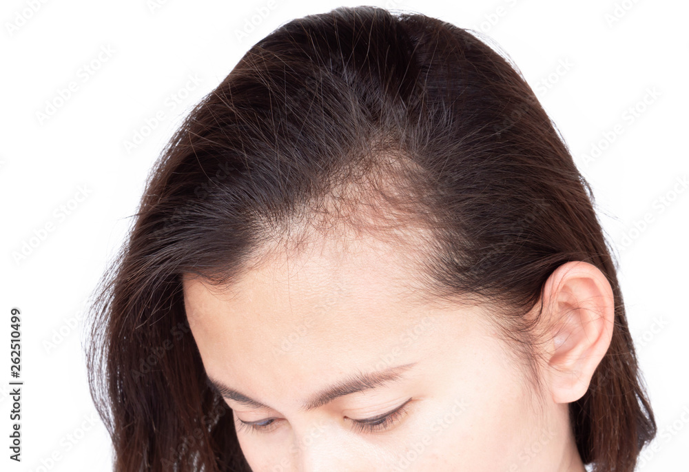 Woman serious hair loss problem for health care shampoo and beauty product concept, selective focus Woman serious hair loss problem for health care shampoo and beauty product concept, selective focus