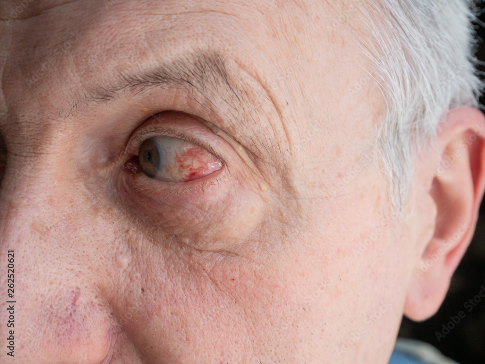 closeup eye of senior old man with red capillars inflammation caused by infection or high blood pressure closeup eye of senior old man with red capillars inflammation caused by infection or high blood pressure
