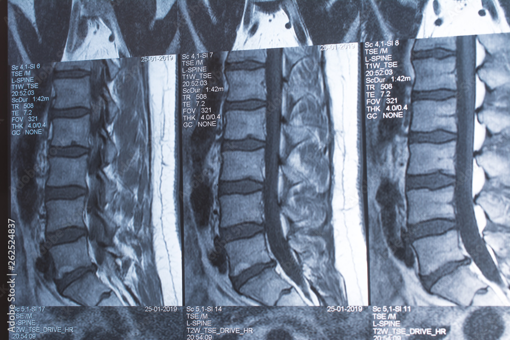 resonance tomography (MRT) of the lumbar spine. Hernia of the