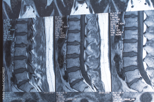 Magnetic resonance tomography (MRT) of the lumbar spine. Hernia of the lumbar spine. Schmorl defects in bodies L3 and L5. Herniated intervertebral disc L5 / S1.