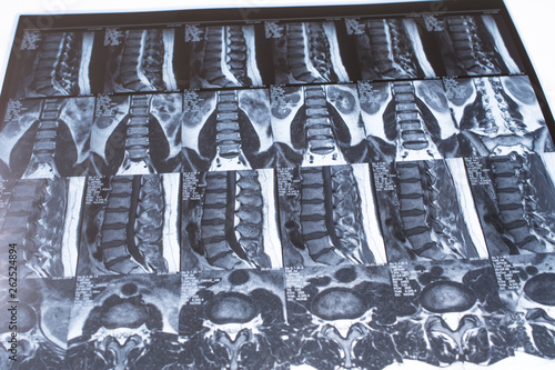 Magnetic resonance tomography (MRT) of the lumbar spine. Hernia of the lumbar spine. Schmorl defects in bodies L3 and L5. Herniated intervertebral disc L5 / S1. photo