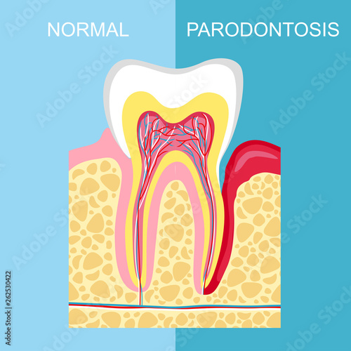 healthy tooth and tooth with periodontal disease. anatomy of human organs. Tooth periodontal disease.  image tooth Periodontitis disease.