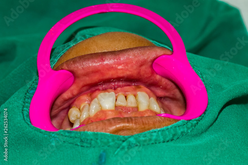 Close up human patient open mouth showing caries teeth decay with gingivitis.