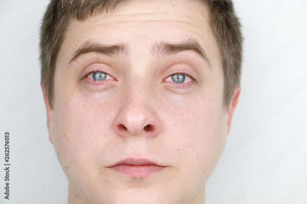 Ophthalmology, allergies, tearing. Portrait of a man who is crying Ophthalmology, allergies, tearing. Portrait of a man who is crying