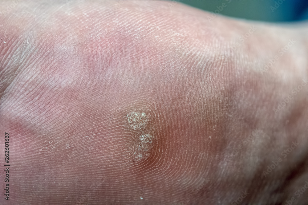 Closeup of foot with an infected wart (Verruca) Closeup of foot with an infected wart (Verruca)