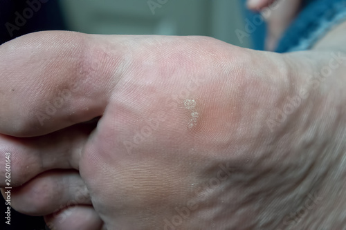Closeup of foot with an infected wart (Verruca)