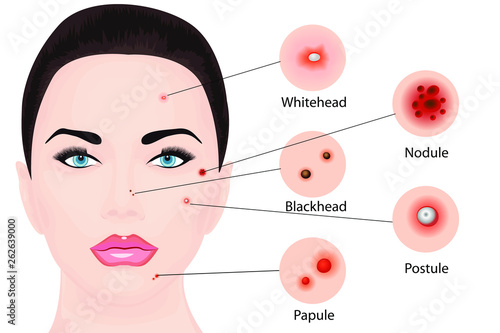 Acne types on a face vector illustration. Cosmetology skincare, skin treatment
